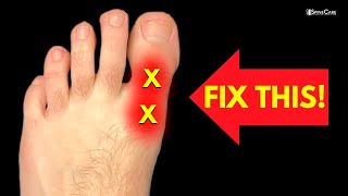 How to Fix BIG TOE Pain for Good [upl. by Atsahc701]