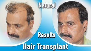 Hair transplant amp designing according to the age of the person  Medispa Jaipur  India  Dr Suneet [upl. by Irvin609]