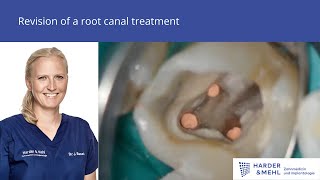 Revision of a root canal treatment [upl. by Sartin]