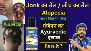 Jonk Ka Tel  Leech Oil  Alopecia  गंजापन दूर करने के घरेलू उपाय  Kaise Kare Use  Results [upl. by Aleahs]