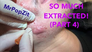 So much extracted Severe acne before and after Session 2 Comedones for days [upl. by Atileda929]