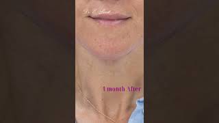 Neck lift Before amp After [upl. by Nauqahs]