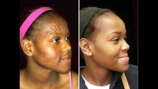 Acne Care for Black Skin  Before amp After Images [upl. by Scrope194]