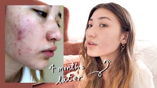 how i fiNalLY cleared my skin [upl. by Lefty]