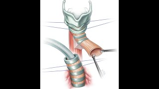 Estenosis traqueal post intubación orotraqueal por Covid 19 [upl. by Helbonia415]