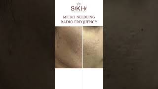 Micro Needle Treatment for Acne  Before amp After  Sikhi Skin Clinic Kondapur Hyderabad skincare [upl. by Ainorev]