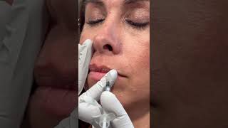 botox lip flip 5 units in 4 injection points for wrinkles amp aesthetics lipflip botox [upl. by Amekahs]