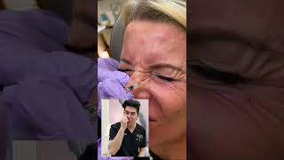 NOSE JOB WITH BOTOX [upl. by Fortunato]