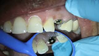 How a Dentist do Implant Crown  Part 1  Implant Crown Impression Making  Measurement Taking [upl. by Nohsreg518]