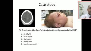 Case 134 hemorrhagi shock subgaleal hemorrhage SGH extra cranial bleeding cephalhematoma cap [upl. by Duky]