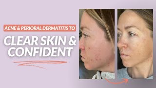 Acne amp Perioral Dermatitis to Clear Skin amp Confident  Katie Stewart Wellness Reviews [upl. by Willamina363]