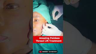 Amazing painless Thread Lift Treatment At Shobhit Aesthetics threads [upl. by Park]