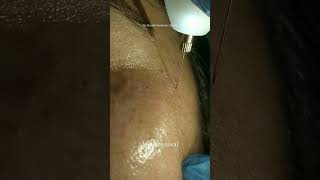 Milia is a keratin filled clog of an eccrine sweat gland Heres how we treat it dermatologist [upl. by Cacia]