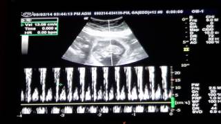 Baby 12 Week Ultrasound amp Heartbeat [upl. by Luigi]