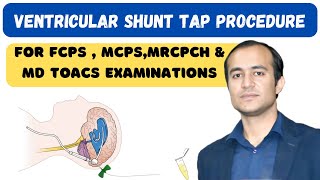 Ventriculoperitoneal Shunt Tap Procedure amp Blockage Diagnosis  shunt patency and radiology [upl. by Haraz]