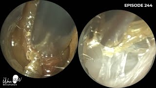 244  Why is this Eardrum Pulsating after Ear Wax Removal using the WAXscope®️ [upl. by Araj]