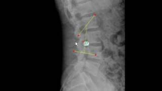 TraumaCad  Lumbar Lordosis Angle [upl. by Ketchan]