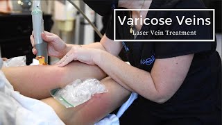 Getting Rid of Varicose Veins  Laser Spider Vein Treatment [upl. by Arni388]