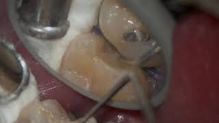 Maxillary Second Molar Class II Inlay Preparation [upl. by Jackqueline]