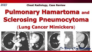 Pulmonary hamartoma amp Sclerosing pneumocytoma [upl. by Tammy]