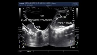 Pyonephrosis associated with pyoureter and a large ureteric stone [upl. by Lavro990]