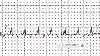 ECG Features of Hyperkalemia [upl. by Kam]