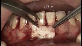 Implants Dentaires  Greffe gingivale libre [upl. by Hauck676]