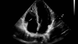 A4C Apical 4 chamber [upl. by Ylloh]
