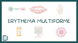 Erythema Multiforme EM Causes Diagnosis Types and Management [upl. by Norris]