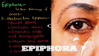 What is EpiphoraWatery Eye   Causes  examination  treatment [upl. by Yesnil480]