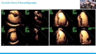 Multimodality Imaging Hypertrophic Cardiomyopathy [upl. by Marja]