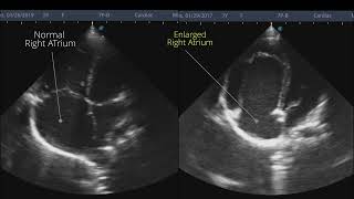 Ebsteins anomaly  Point of Care ECHO  Short Video [upl. by Cordula]