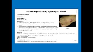 Bestrahlung bei Keloid bzw Hypertropher Narbe  Strahlentherapie Prof Hilke Vorwerk [upl. by Cruce]