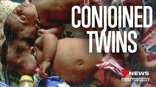 The heartwarming story of Trishna amp Krishna Conjoined twins separated [upl. by Drageruaeb]