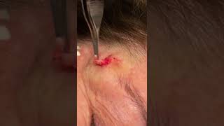 SMALL FACE CYST [upl. by Dnomaid]