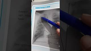 Chest Xray of Bronchial Carcinoma [upl. by Letnwahs]