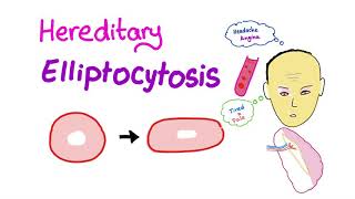 Hereditary Elliptocytosis HE [upl. by Eliga]