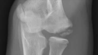 Treatment of Capitellar Osteochondritis Dissecans Using Precut Fresh Osteochondral Allografts [upl. by Annekcm]