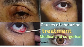 Lecture 3 Chalazion  Eyelid disease optometrist medicalstudent motivation mbbs [upl. by Fullerton]