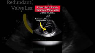 Dilated Aortic Root in Marfan Syndrome heart cardiology echocardiography [upl. by Ennairda]