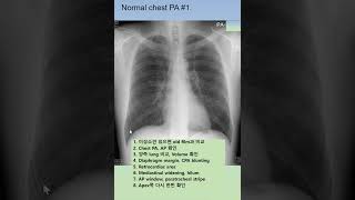 Normal chest PA 정상 흉부 Xray1 shorts [upl. by Standley]