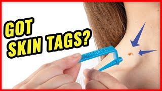 How to Remove Skin Tags Fast with TagBand [upl. by Lawford]