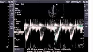 Point of Care Echo Stroke Volume Determination [upl. by Fleck783]