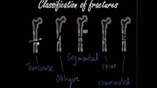 Classifying and presenting Fractures  Orthopaedics for Medical Students  Finals [upl. by Hardigg88]