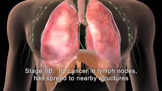 English MAKNA Getting to know Lung Cancer [upl. by Aisaim]