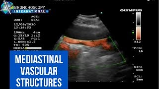 BronchAtlas EBUS and Suspected Pulmonary Embolism [upl. by Howlyn214]