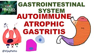 AUTOIMMUNE ATROPHIC GASTRITIS Pathogenesis clinical features morphology amp prognosis [upl. by Ahsened]