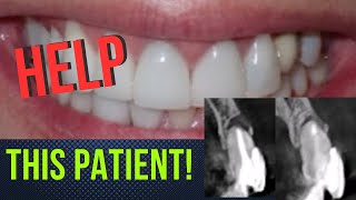 Preserve Teeth Harnessing Patients Healing Ability [upl. by Nnyliak]