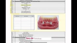 CoverdentureProthesen oder Deckprothesen  HKP abrechnen 34 [upl. by Aynatan]