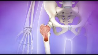 Myelofibrosis  Mayo Clinic [upl. by Viridis]